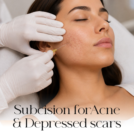 Subcision for acne & depressed scars